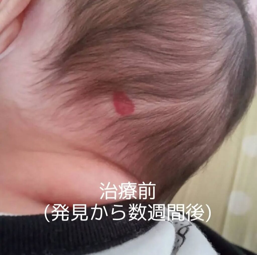 苺状血管腫を発見したときの写真
