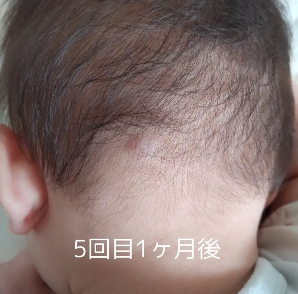 レーザー治療後、5回目の写真