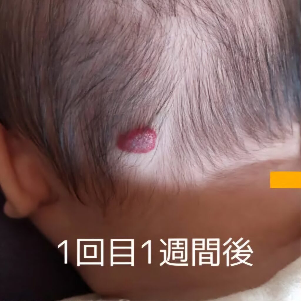 レーザー治療後、1週間後の写真