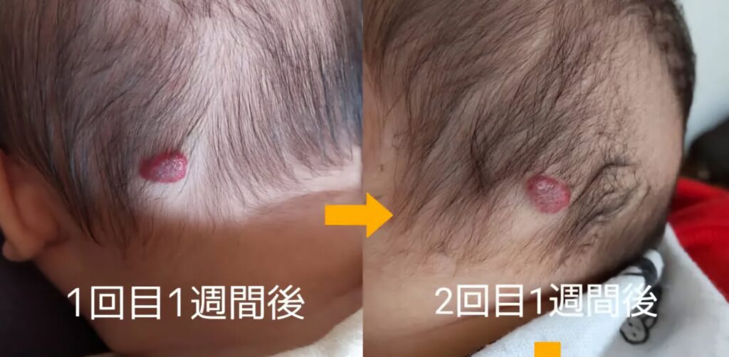 レーザー治療後、1回目と2回目の比較