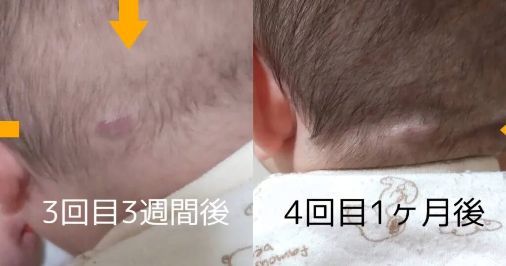 レーザー治療後、3回目と4回目の比較